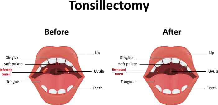 Tonsillectomy
